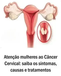Atenção mulheres ao Câncer Cervical: saiba os sintomas, causas e tratamentos