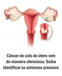 Câncer de colo de útero vem de maneira silenciosa; Saiba identificar os sintomas precoces