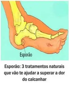 Esporão no calcanhar: 3 medidas naturais que podem ajudar a aliviar a dor em casa