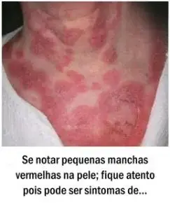 Se notar pequenas manchas vermelhas na pele; fique atento pois pode ser sintomas
