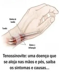 Tenossinovite: uma doença que se aloja nas mãos e pés, saiba os sintomas e causas